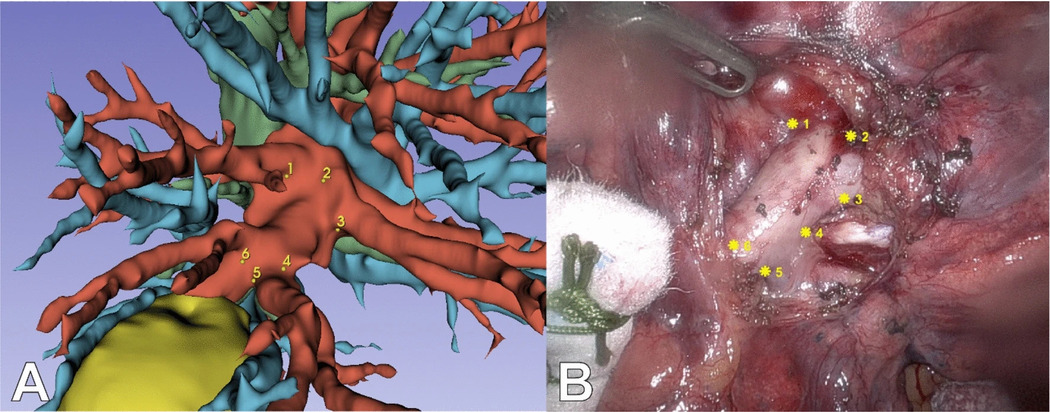 AI Pulmonary Map