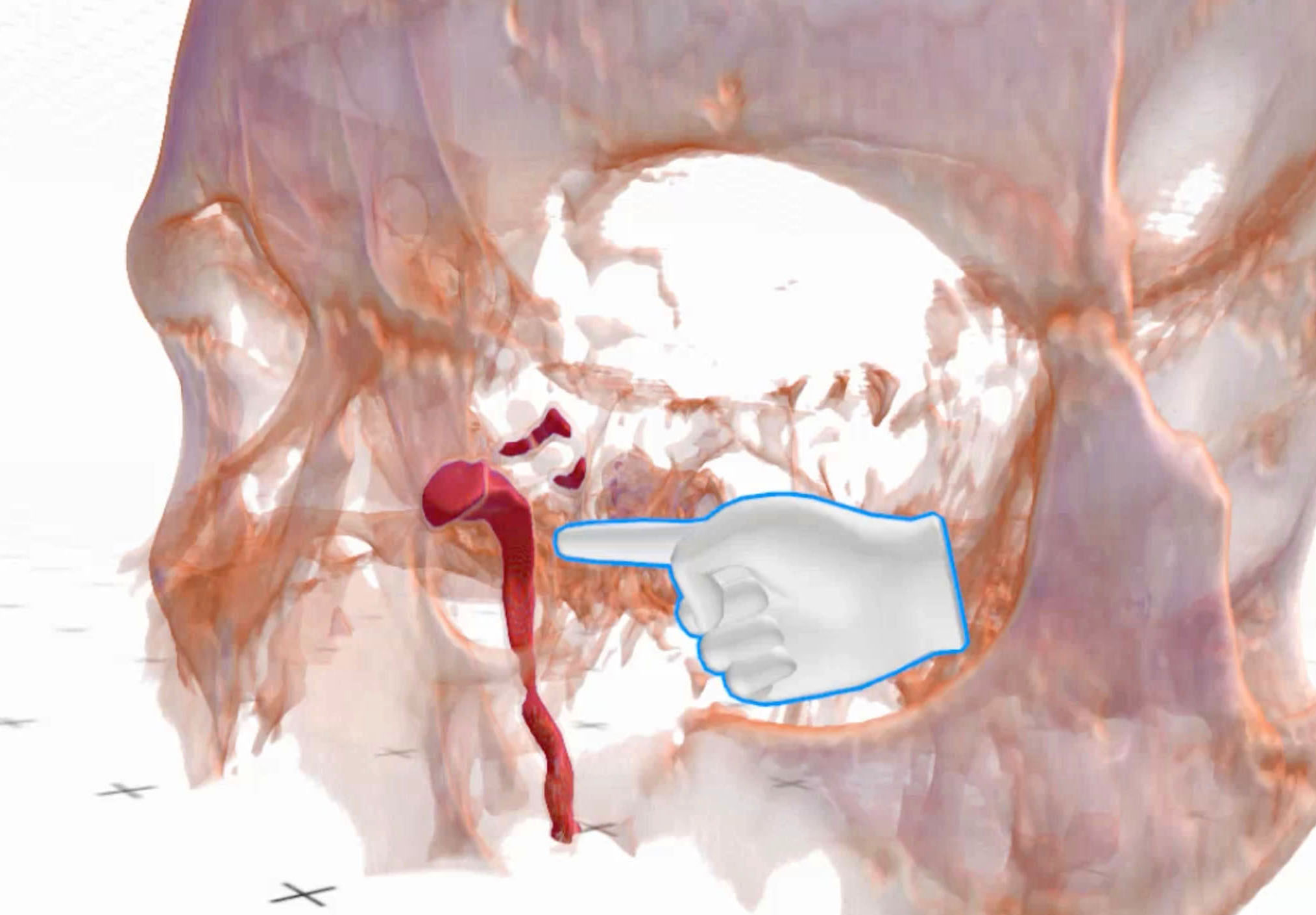 Lacrimal sac reconstruction with virtual reality