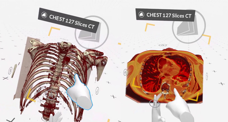 Presentation of a serial rib fracture with fragment dislocation (left) and consecutive haemato-pneumothorax (right)
