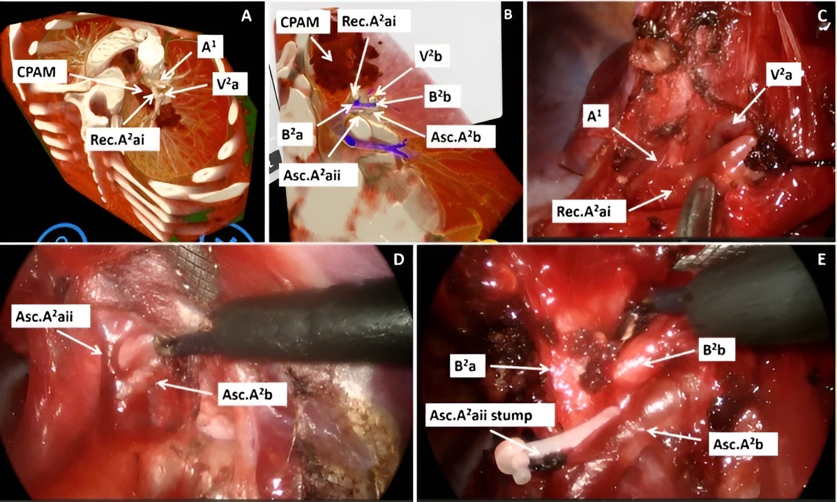 Precision surgery in pediatrics with Virtual Reality