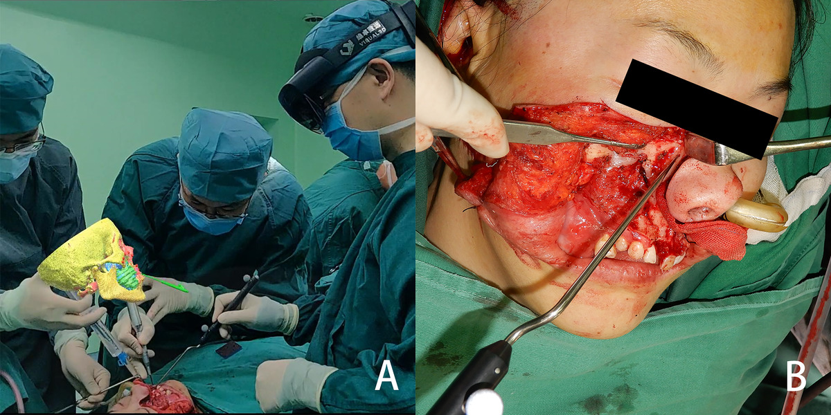 Maxillofacial surgery