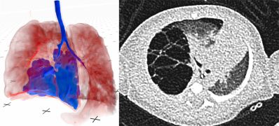 Low-dose CT, high-impact: VR is redefining pediatric surgery